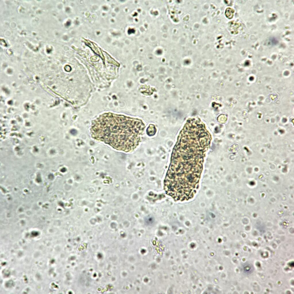 Granular Casts in Urine Sediment