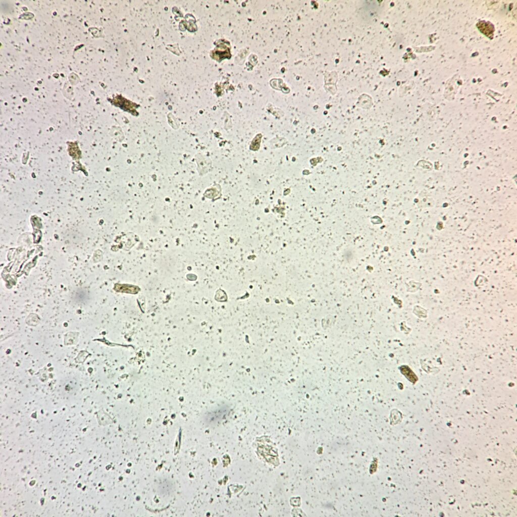 Granular Casts in Urine Sediment