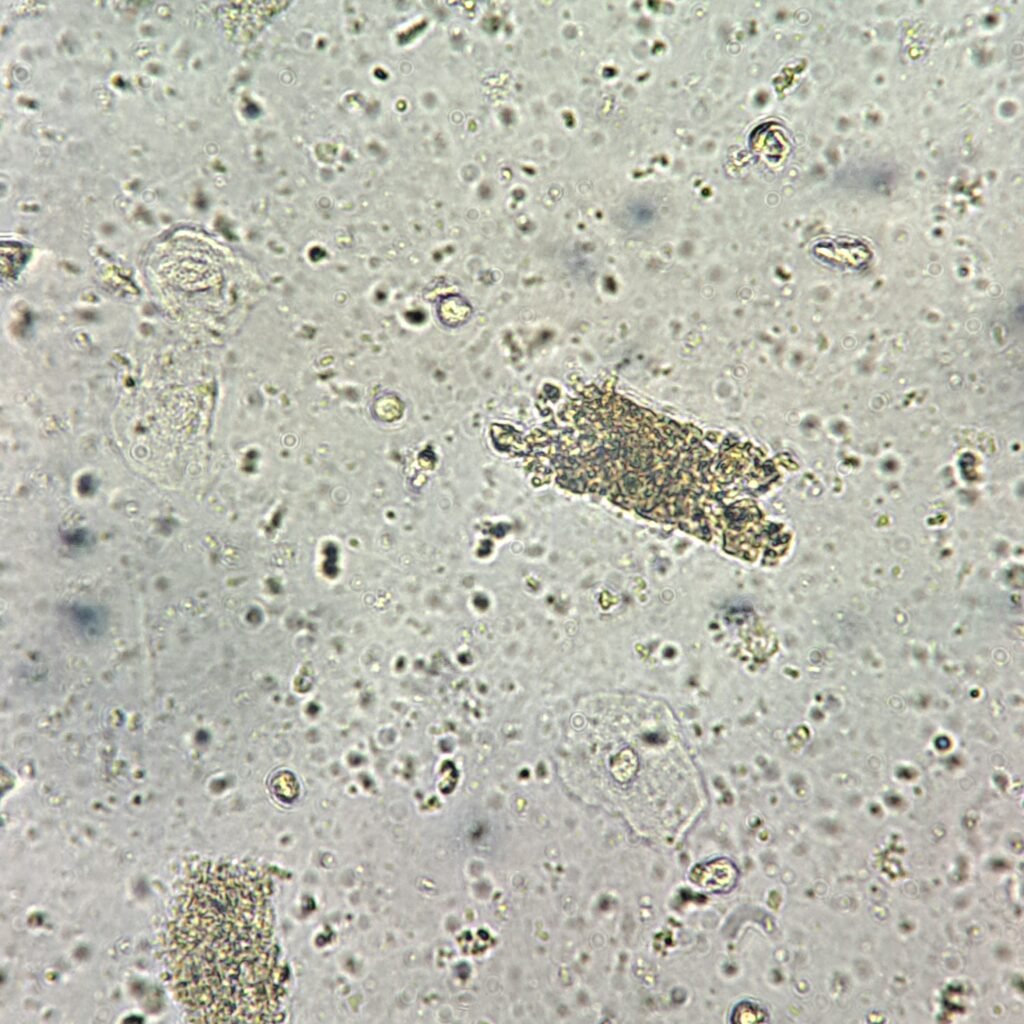 Granular Casts in Urine Sediment