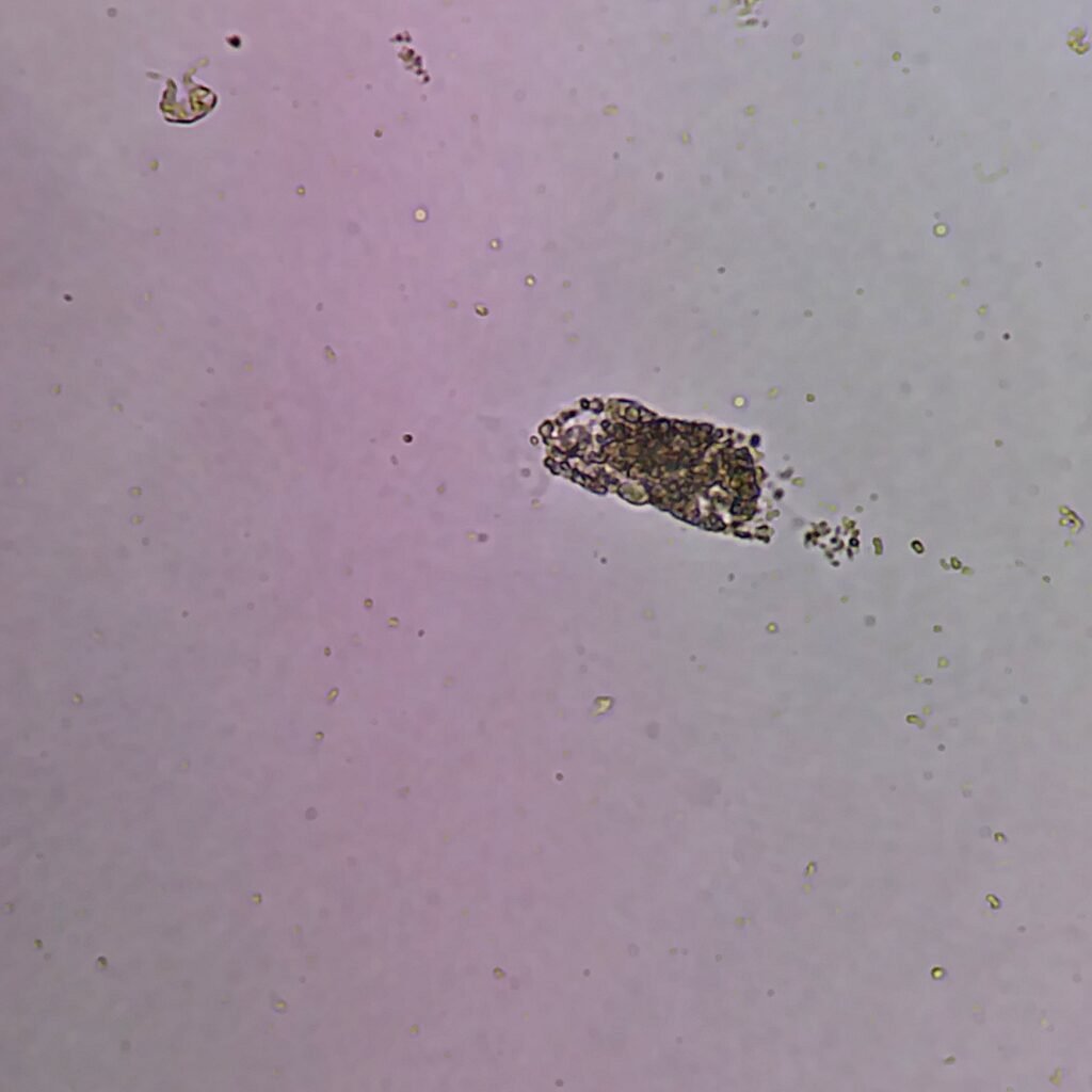 Granular Casts in Urine Sediment