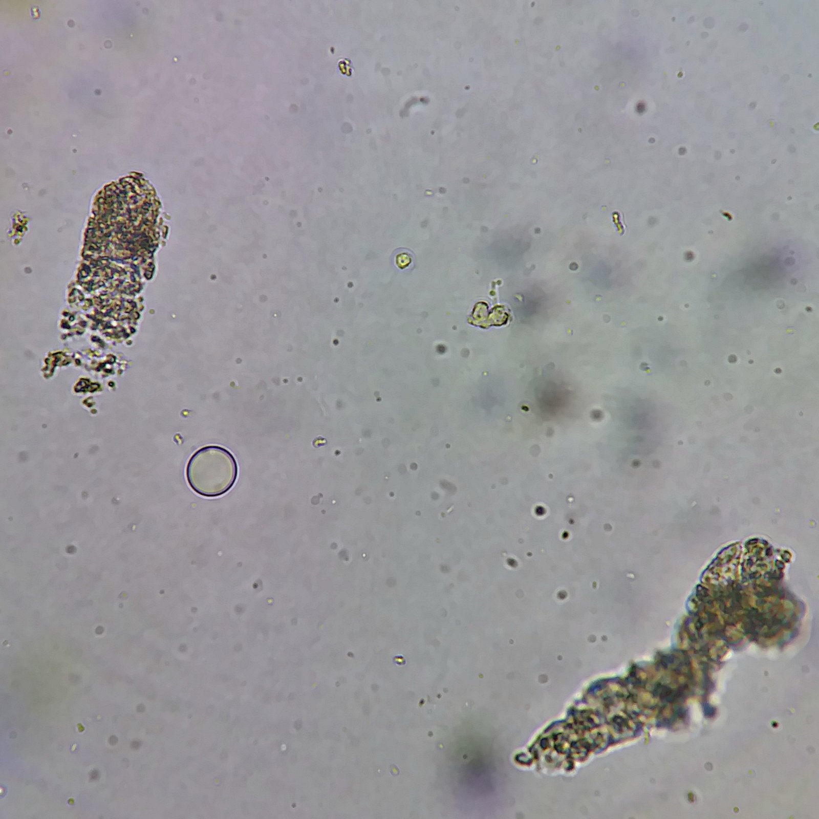 Granular Casts in Urine Sediment