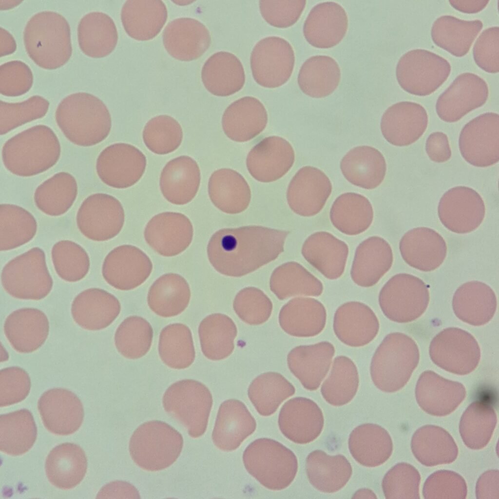 Howell-Jolly Body in RBC