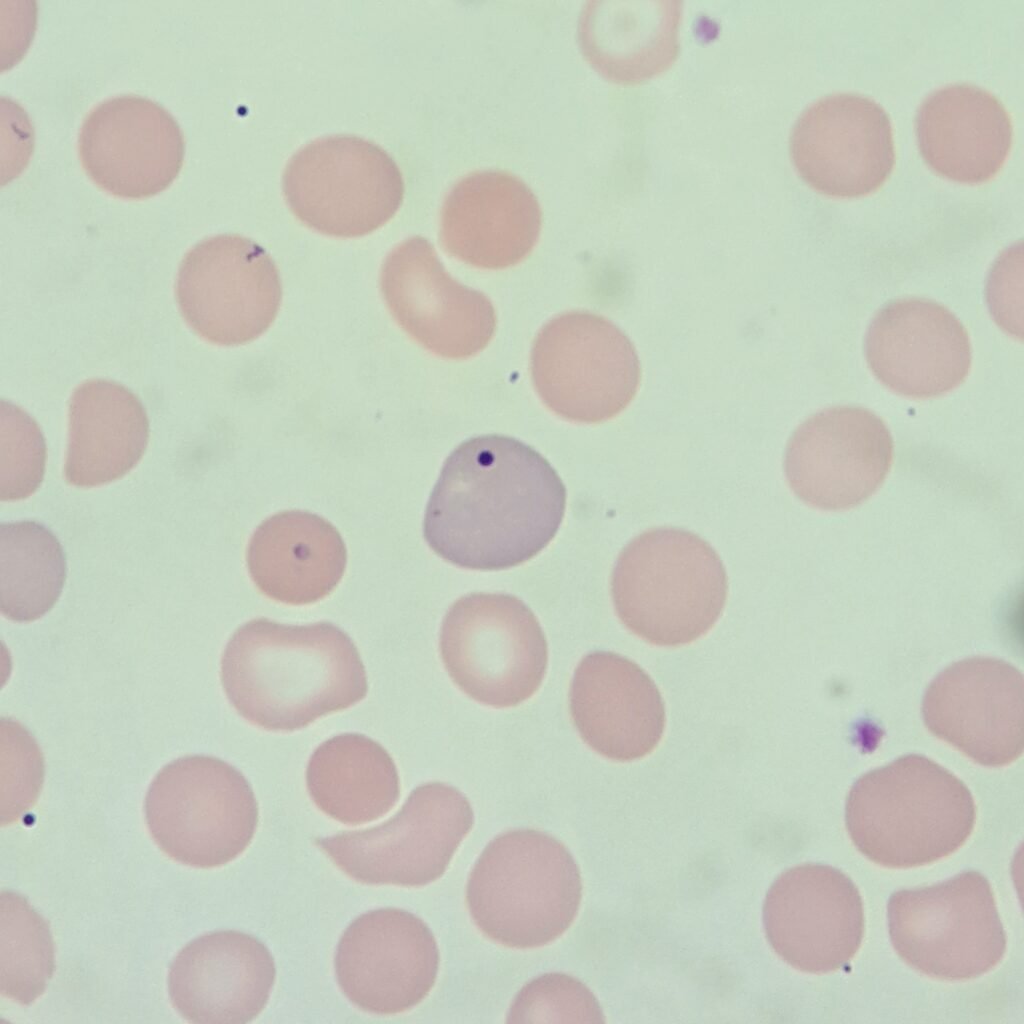 Howell-Jolly Body in RBC