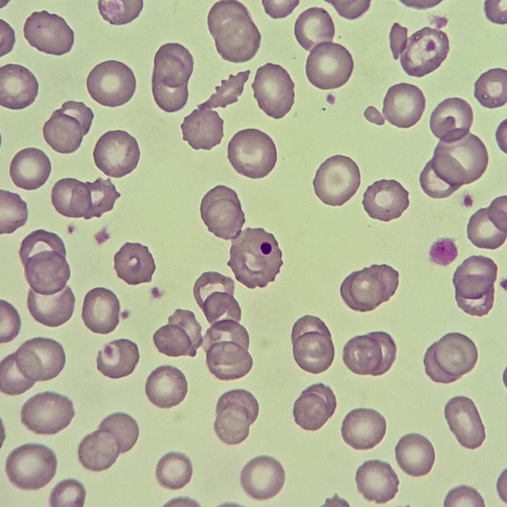 Howell-Jolly Body in RBC