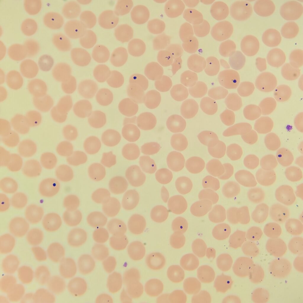 Howell-Jolly Bodies, Red blood cell inclusions