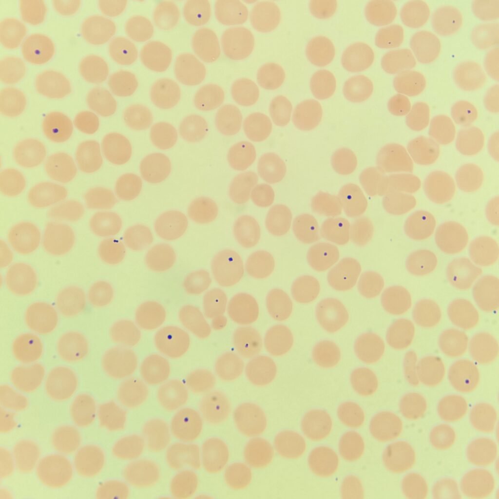 Howell-Jolly Bodies, Red blood cell inclusions