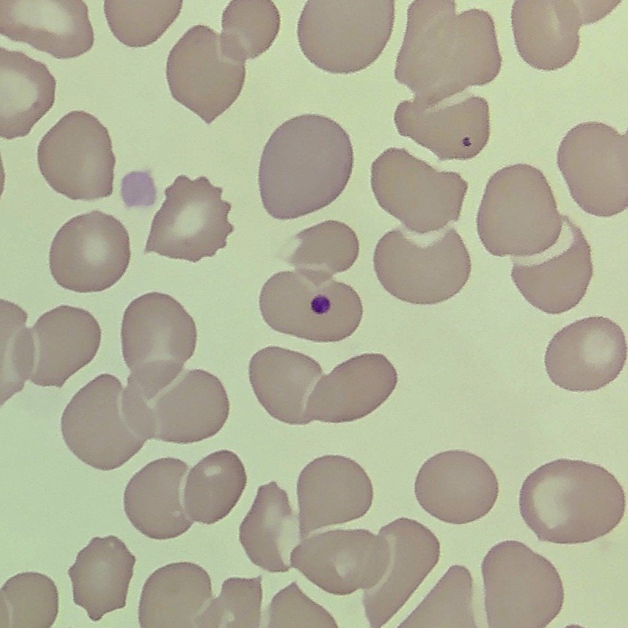 Howell-Jolly Bodies, Red blood cell inclusions