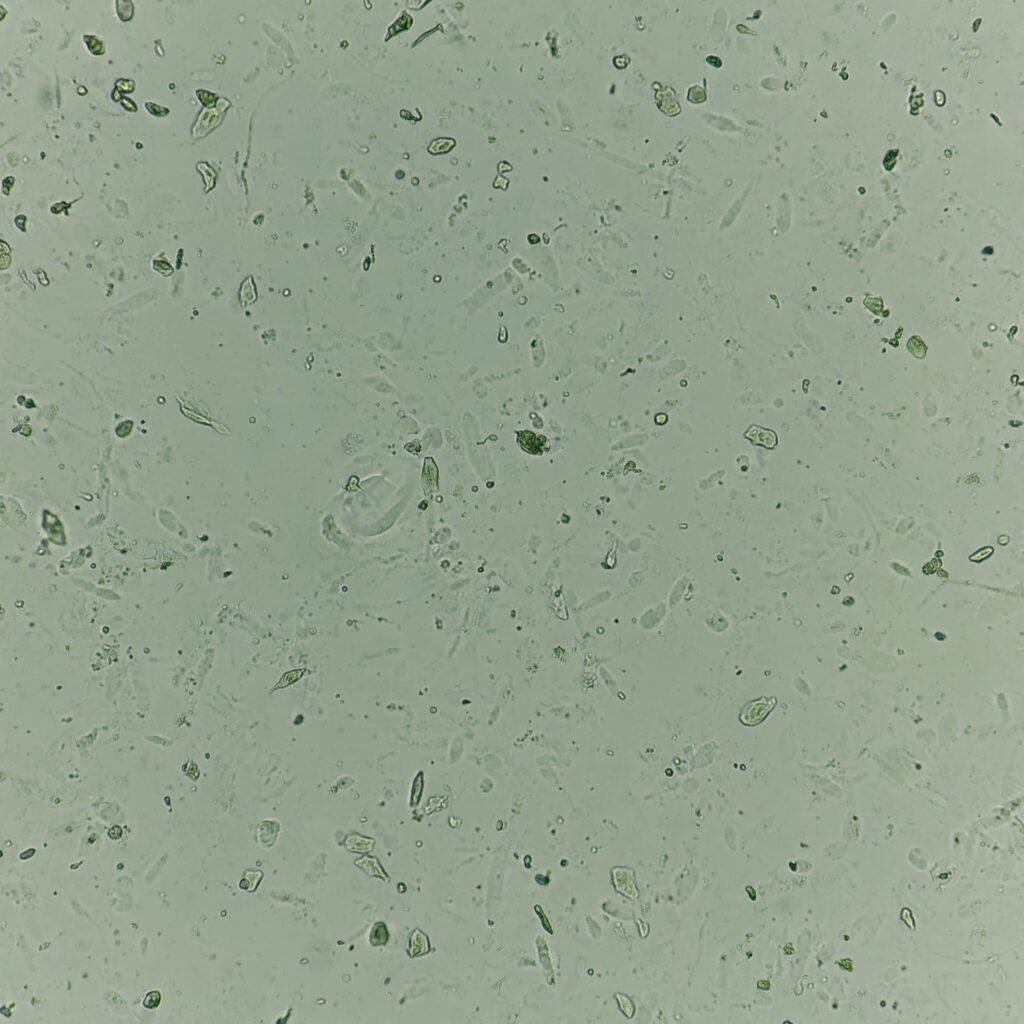 Hyaline Casts in Urine Sediment
