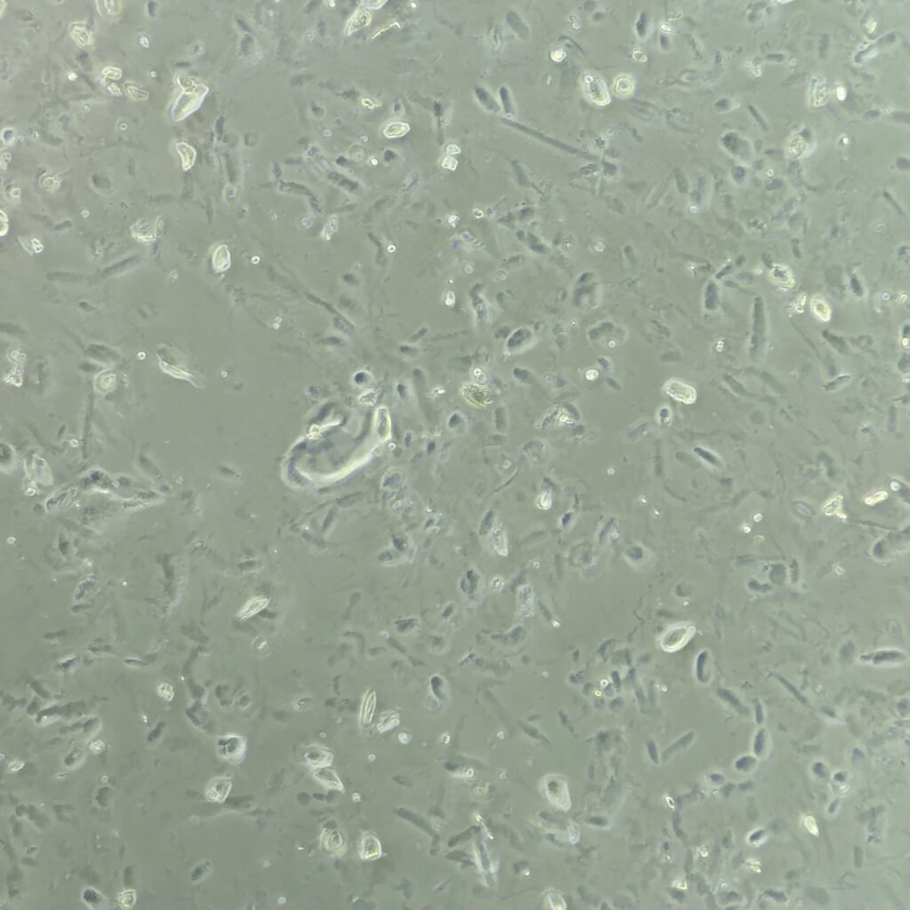 Hyaline Casts in Urine Sediment Under Phase Contrast