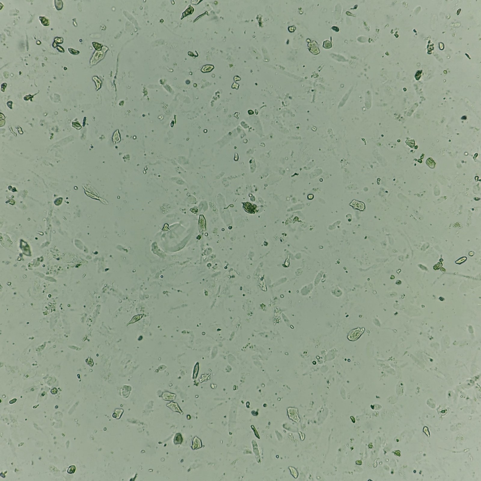 Hyaline Inclusions Hyaline Casts: Identification & Clinical Significance - MedLabBuddy