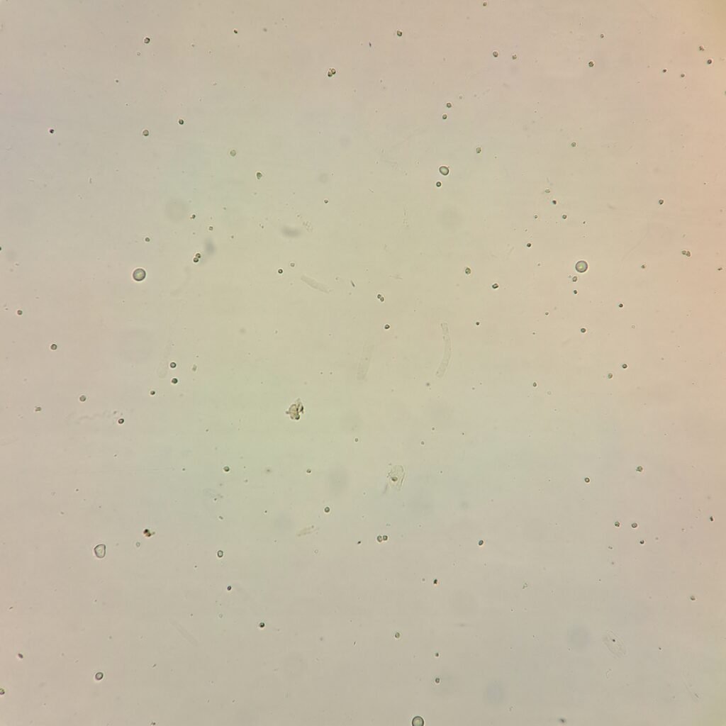Hyaline Casts in Urine Sediment