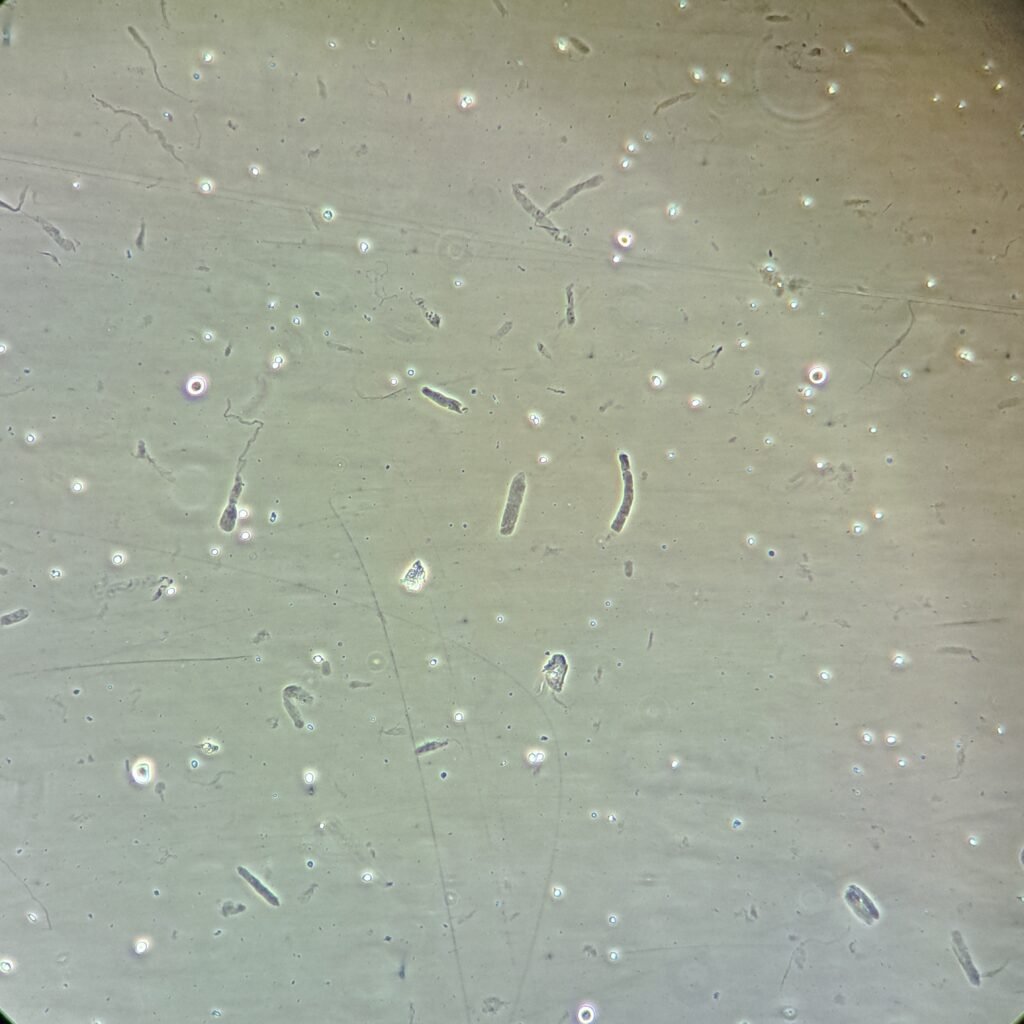 Hyaline Casts in Urine Sediment Under Phase Contrast