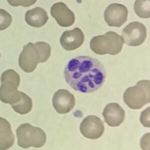 Hypersegmentation: Appearance & Clinical Significance - MedLabBuddy
