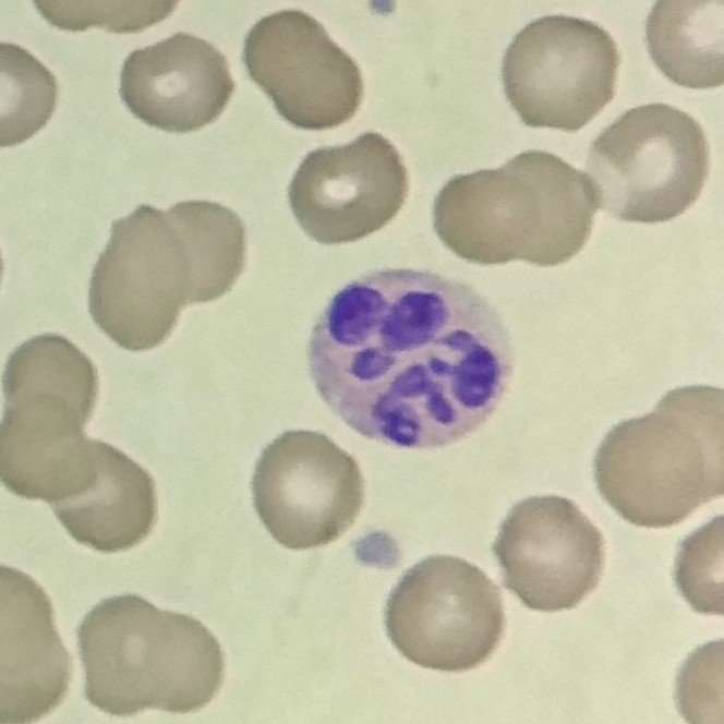 hypersegmented neutrophil