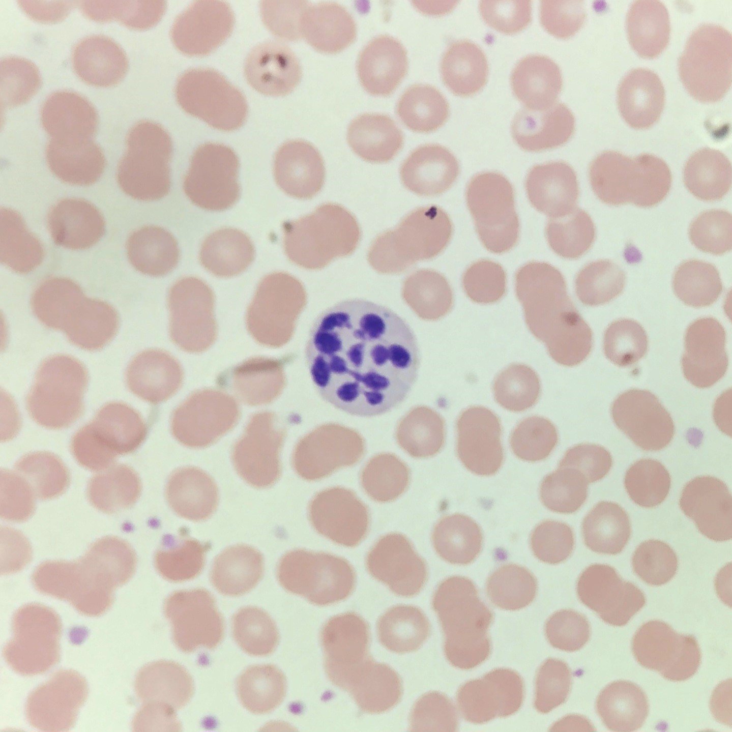 hypersegmented neutrophil, a type of White Blood Cell