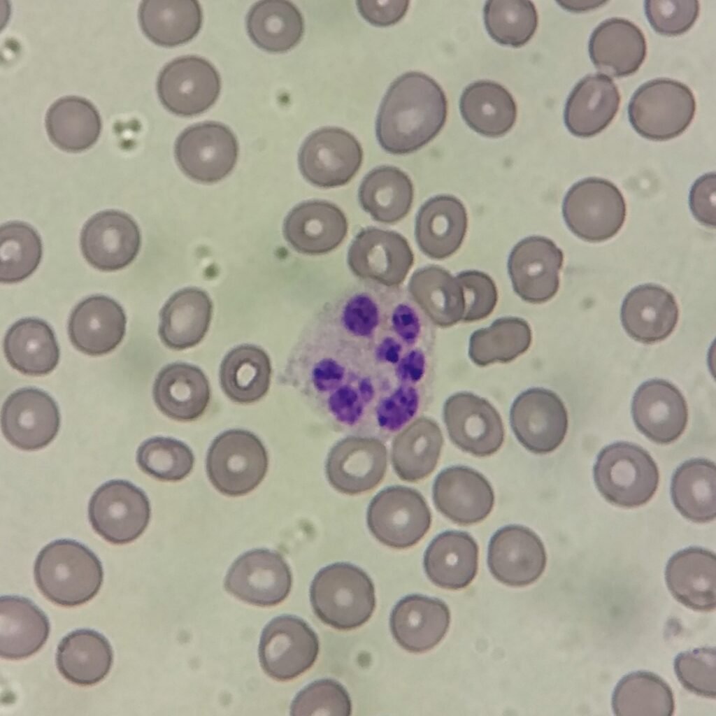 hypersegmented neutrophil