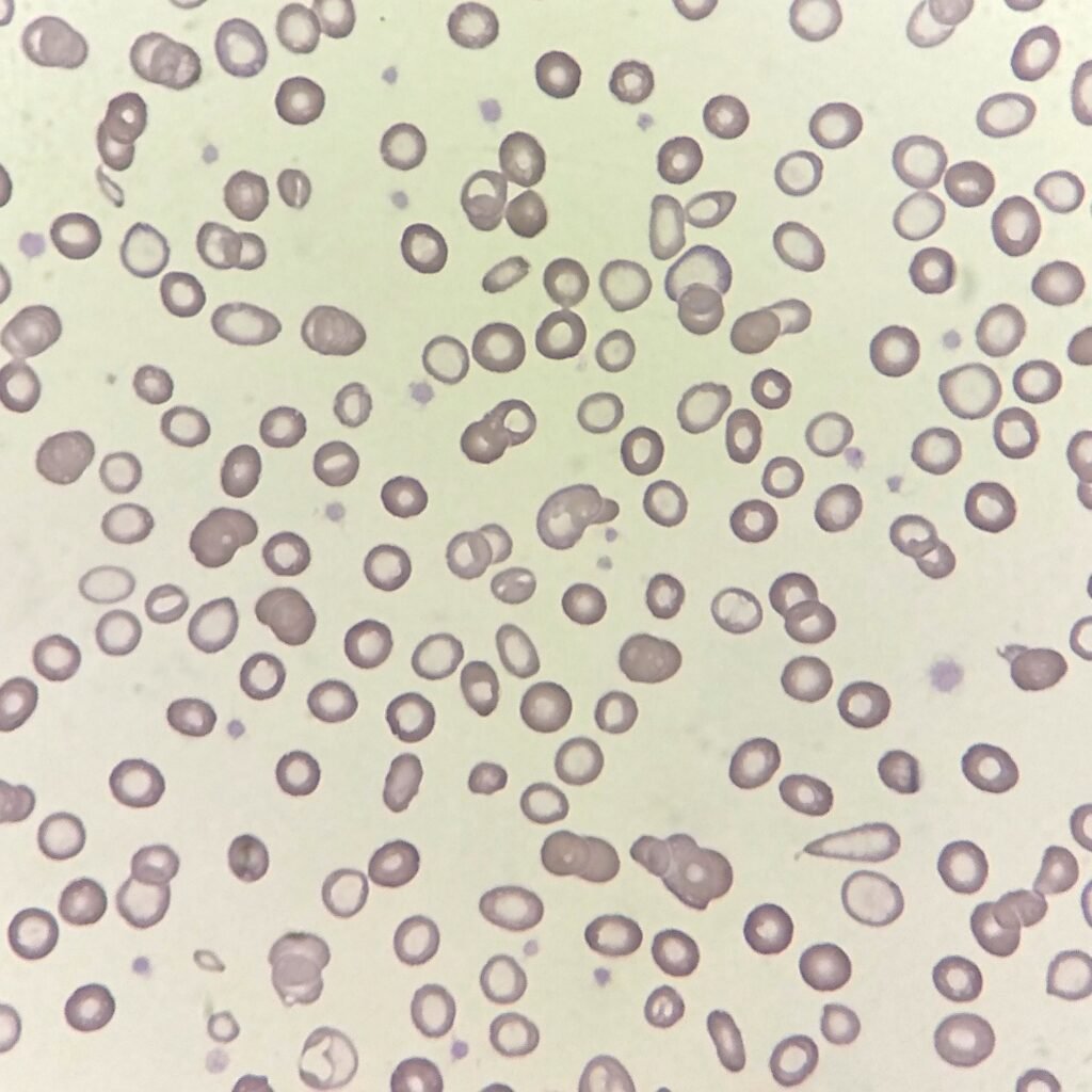 RBC Morphology based on Indices, Low MCHC, Hypochromasia, Increased Central Pallor