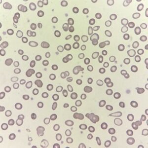 RBC Morphology Based on Indices