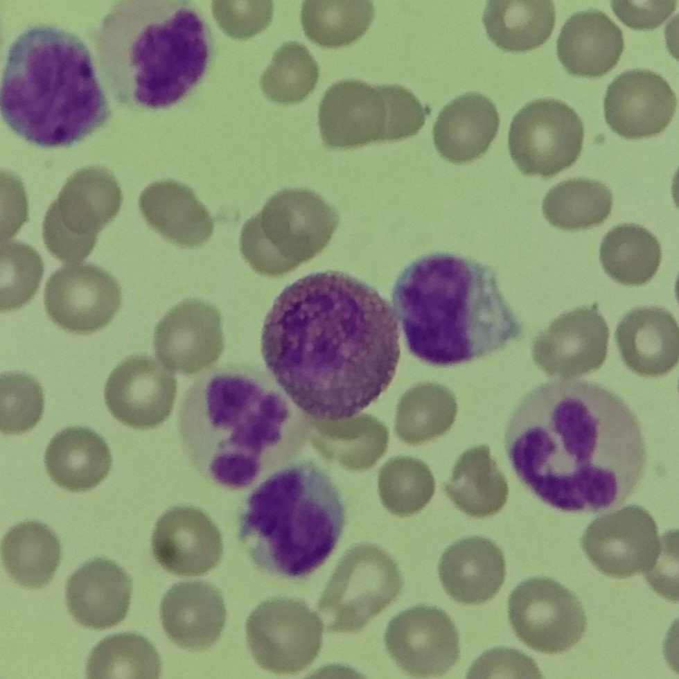 white blood cell: immature eosinophil