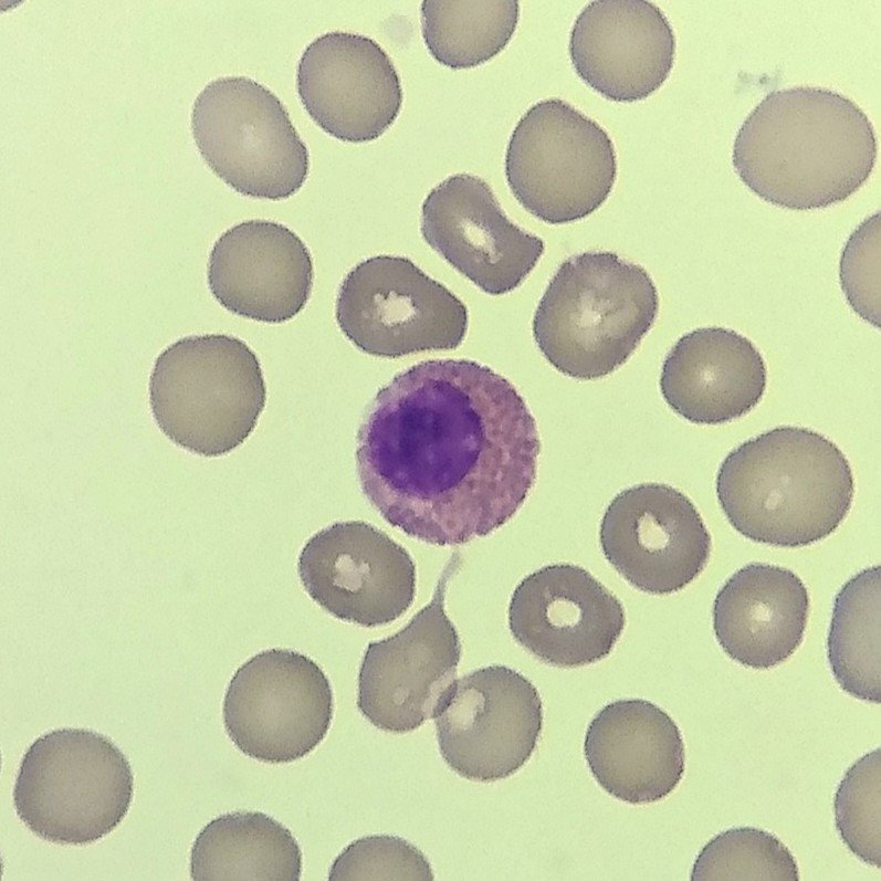 white blood cell: immature eosinophil