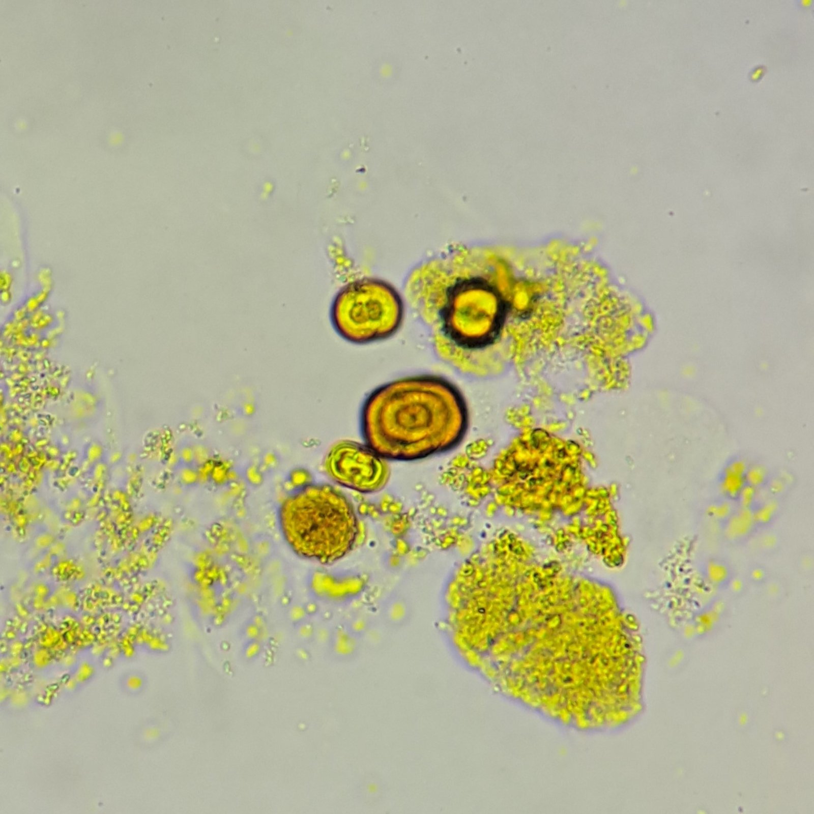 Leucine crystals in urine
