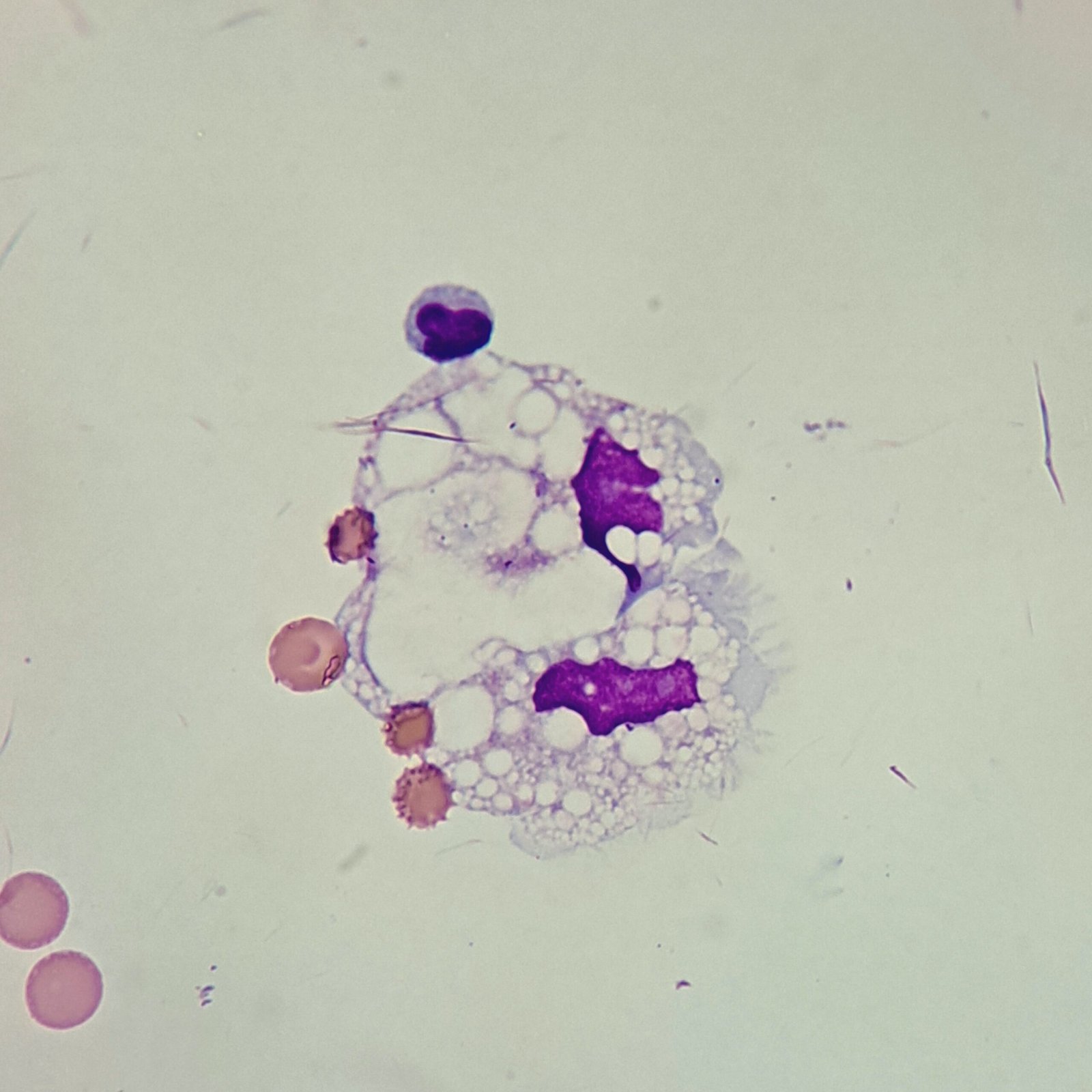 Lipophage: macrophage with abundant lipid vacuoles