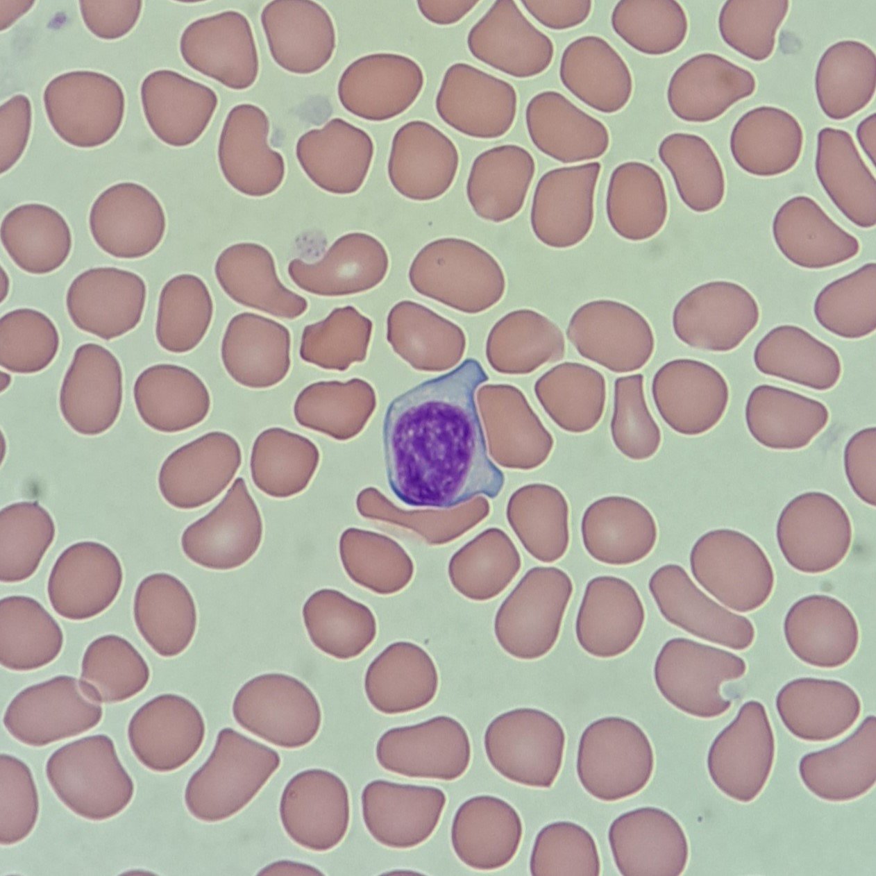 Activated Lymphocyte, White Blood Cell