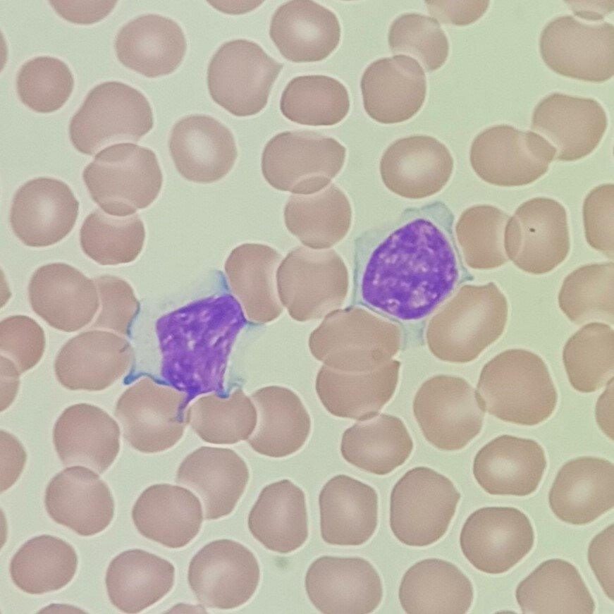 Activated Lymphocyte, a type of White Blood Cell