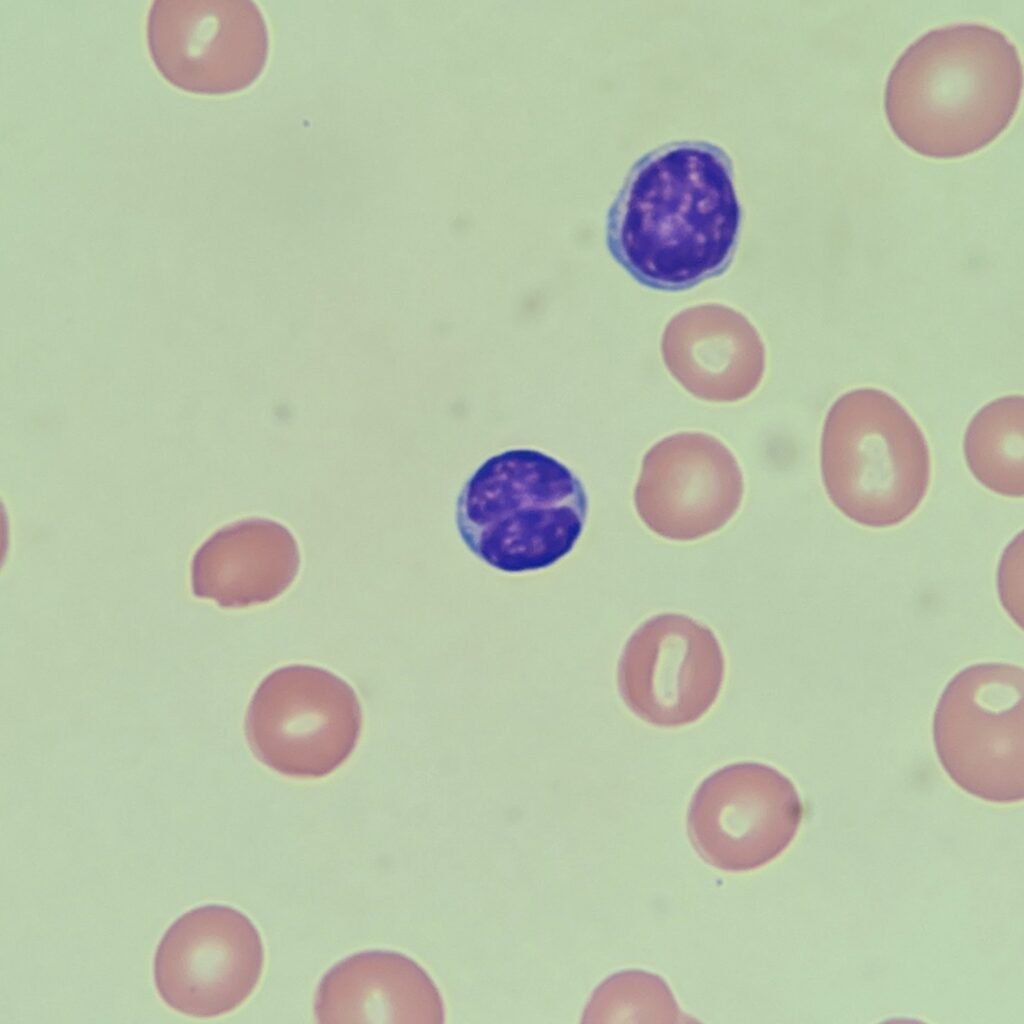 cleaved lymphocytes (butt cells)