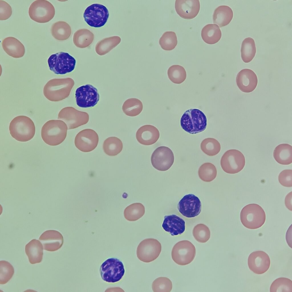 cleaved lymphocytes (butt cells)