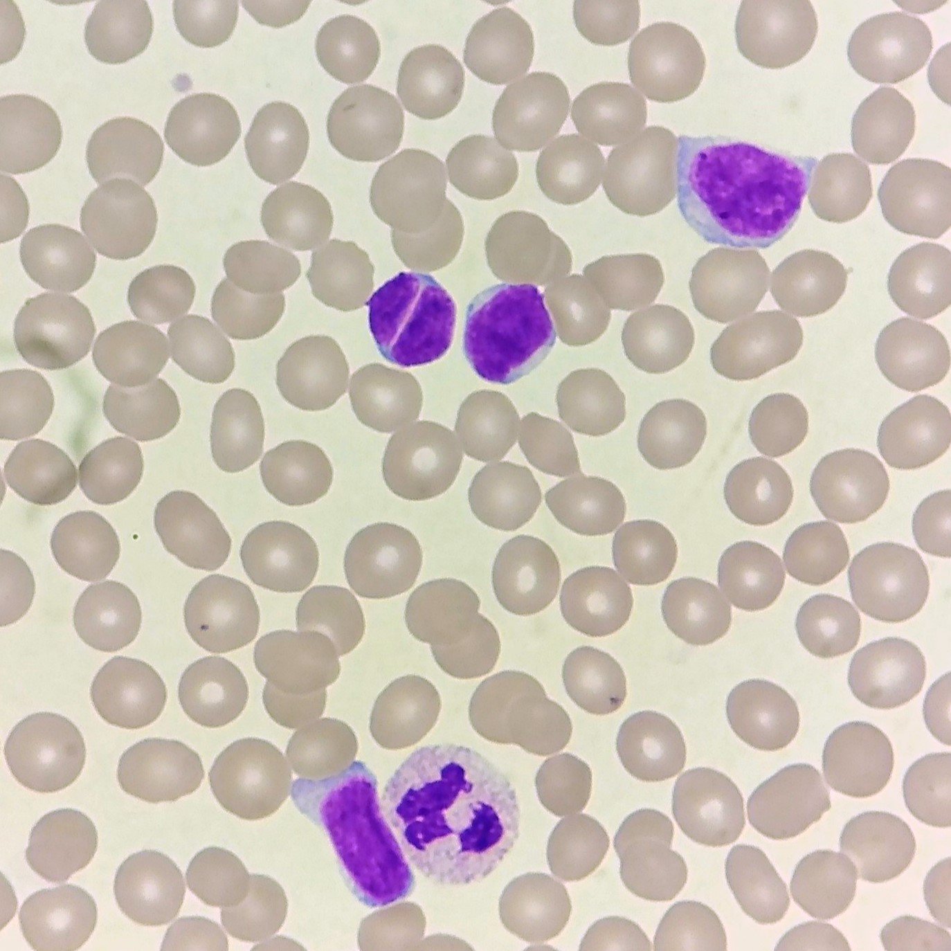 Microscopic image of blood cells featuring a mix of red blood cells and white blood cells, including cleaved lymphocytes, AKA Tush cells.