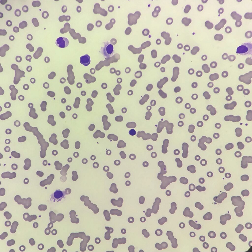 hairy cells