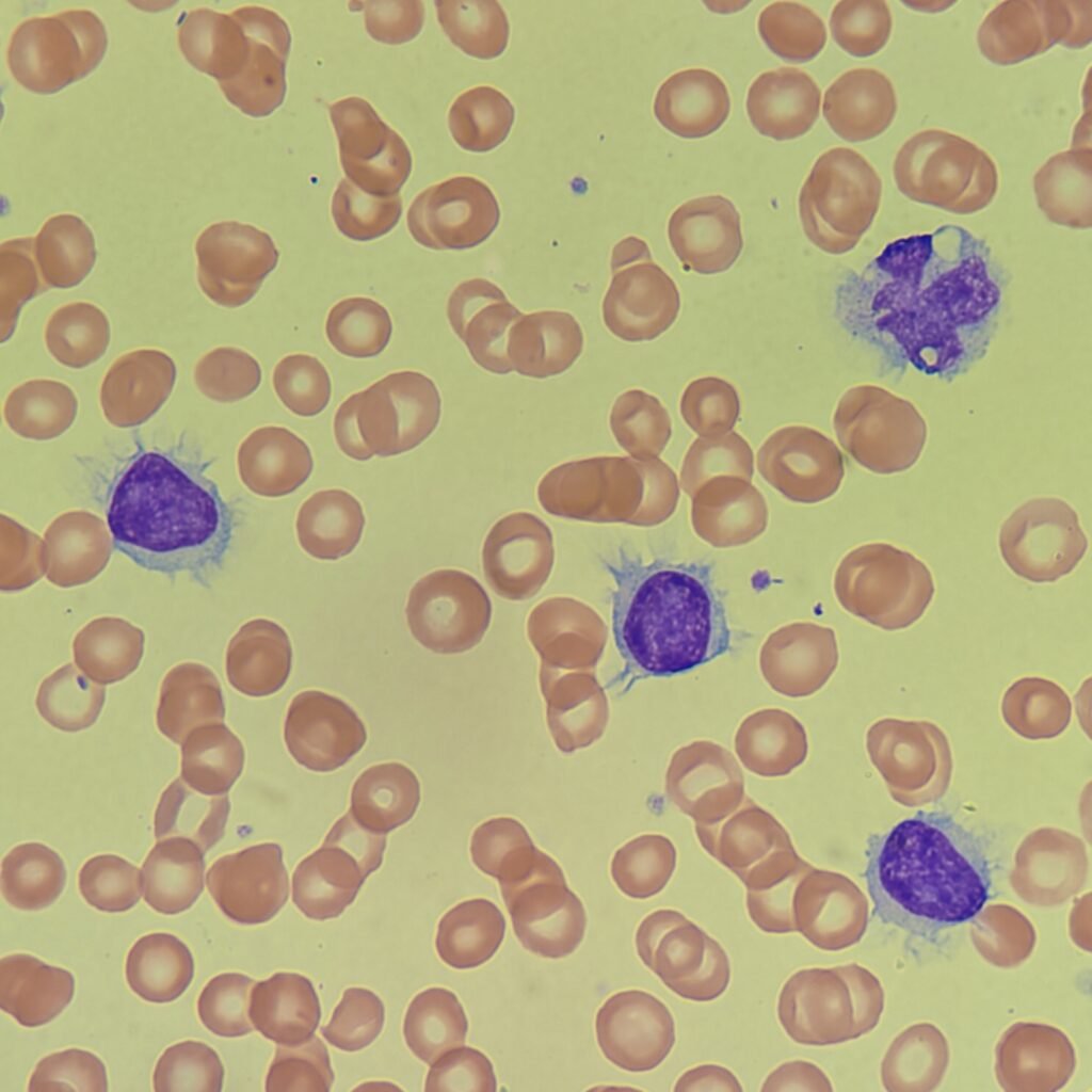 Hairy Cell, Lymphocyte, White Blood Cell