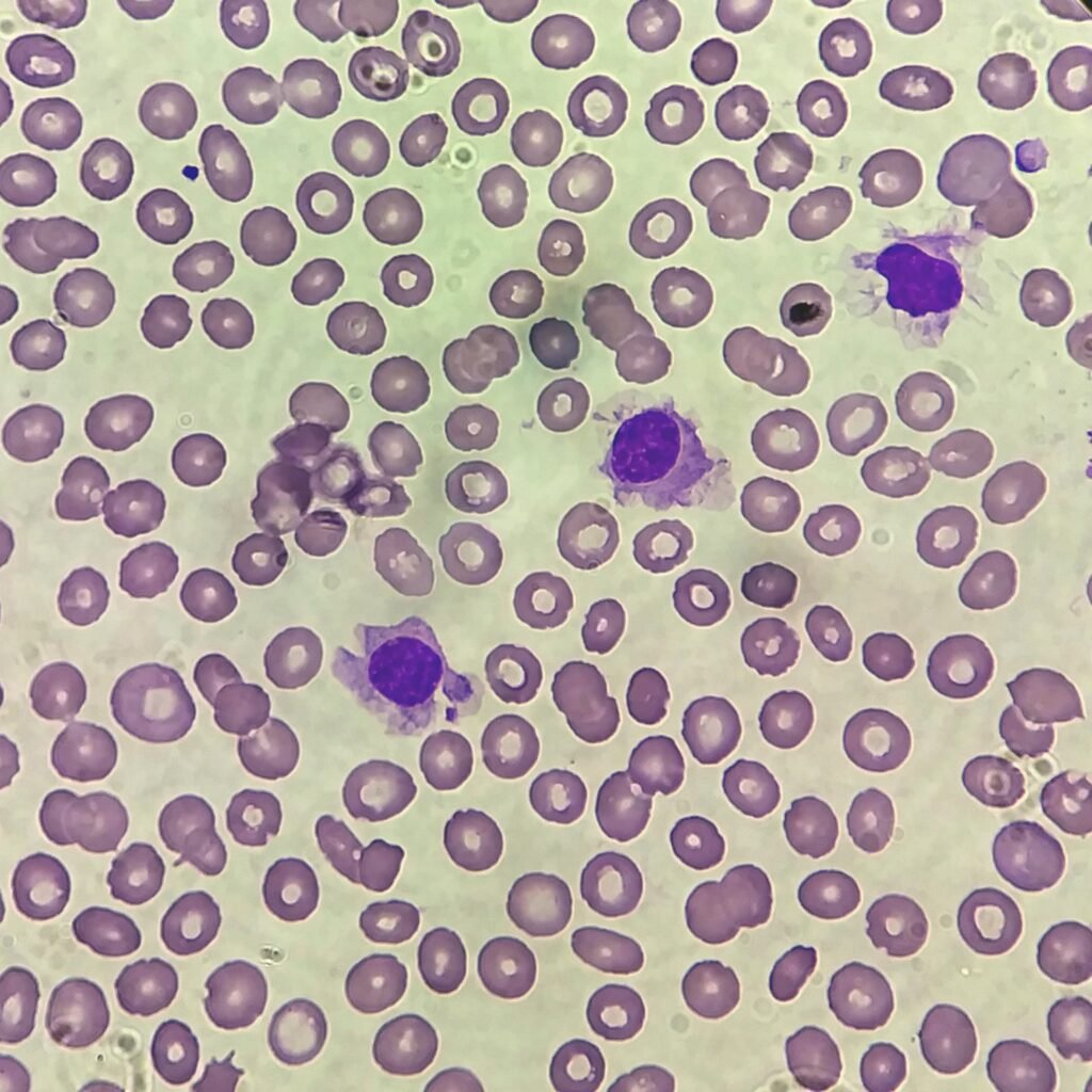 hairy cells