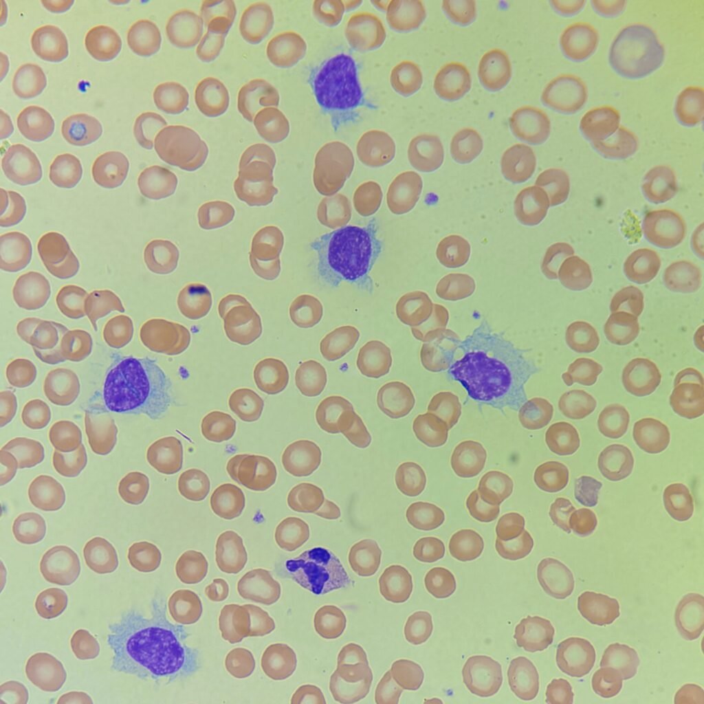 Hairy Cell, Lymphocyte, White Blood Cell