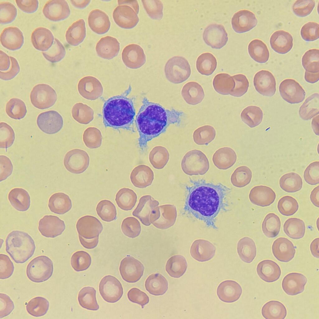 Hairy Cell, Lymphocyte, White Blood Cell