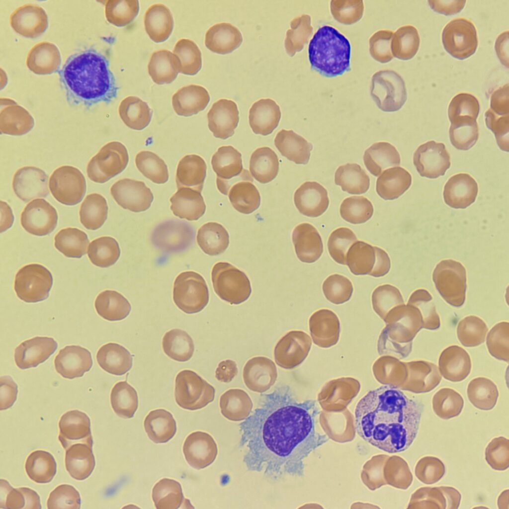 Hairy Cell, Lymphocyte, White Blood Cell
