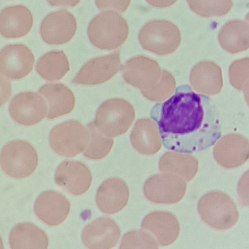 Large Granular lymphocyte, a type of White Blood Cell.