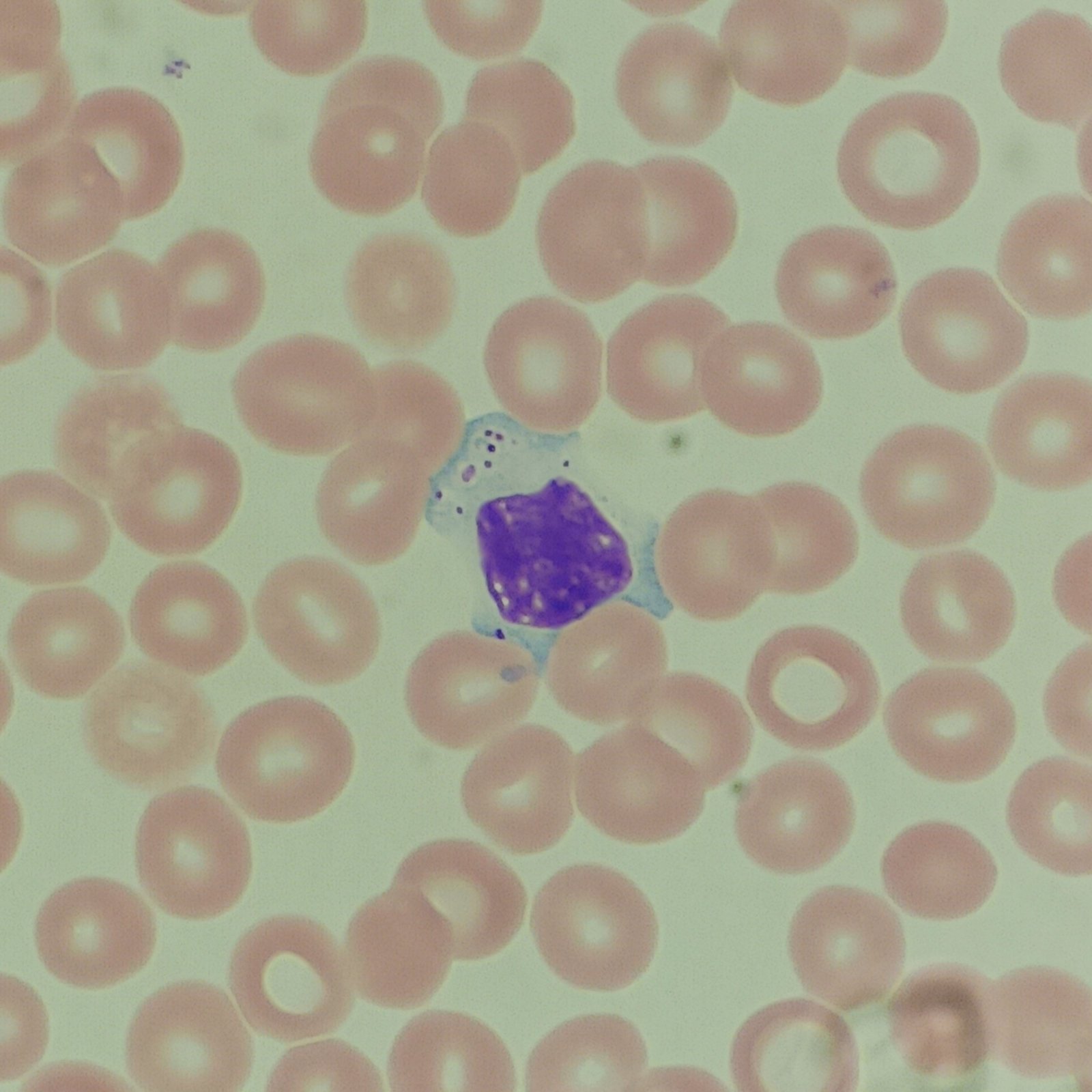large granular lymphocyte