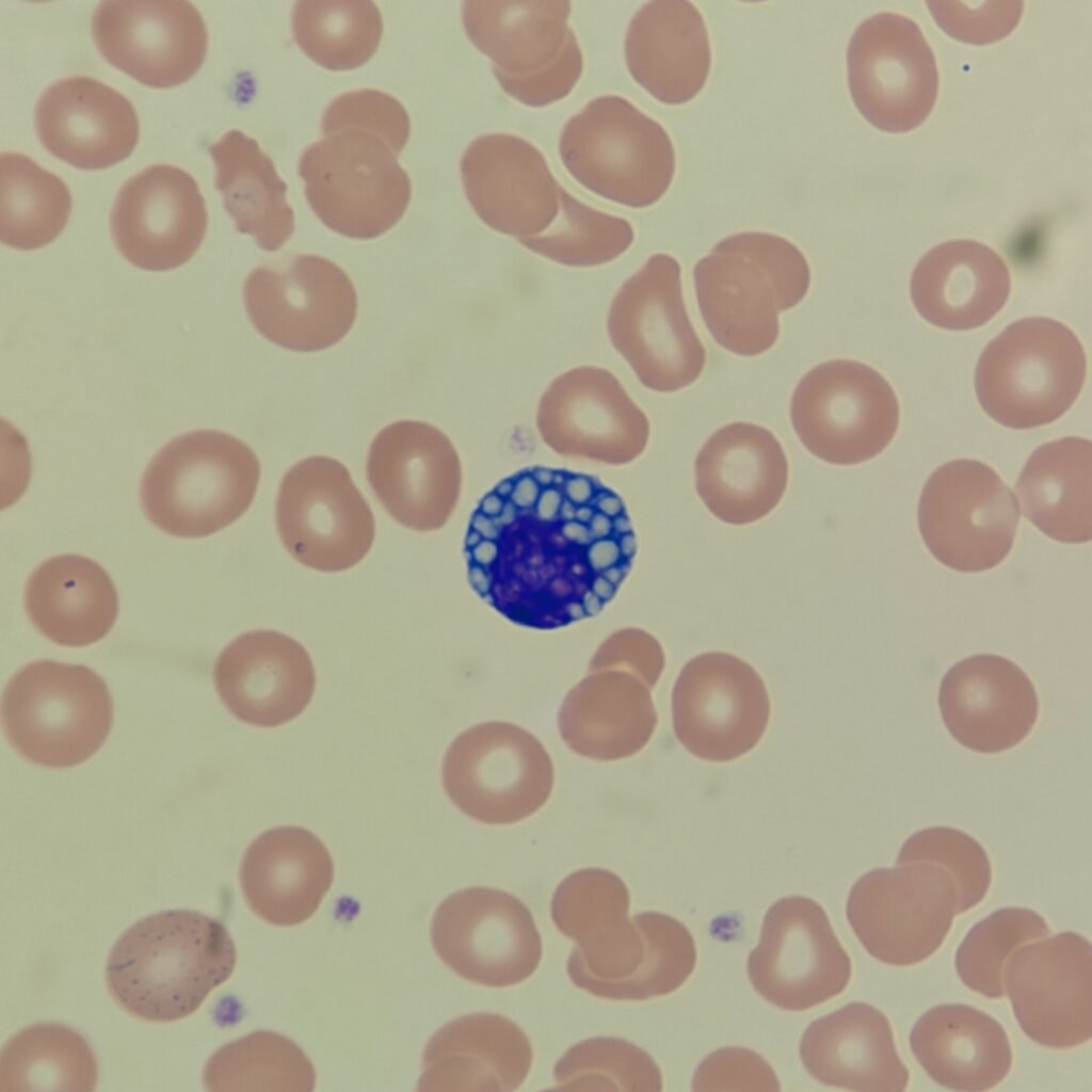 Mott Cell, Lymphocyte, White Blood Cell