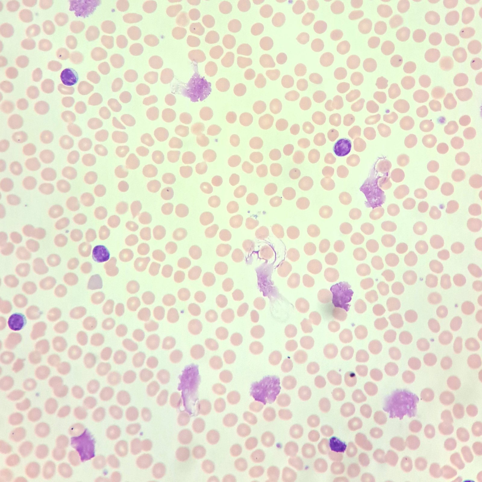 Microscopic image of blood cells featuring a mix of red blood cells and white blood cells, including smudge/basket cells, or remnants of lymphocytes.