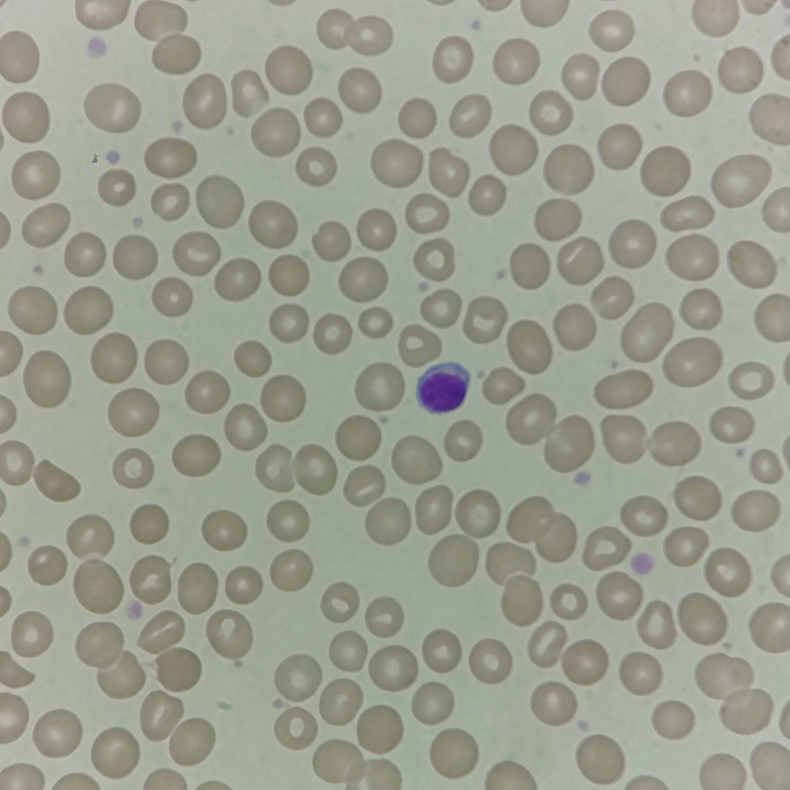 Stabilized Rbc Cell RBC Morphology Based on Indices