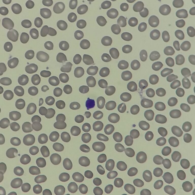 RBC Morphology Based on Indices