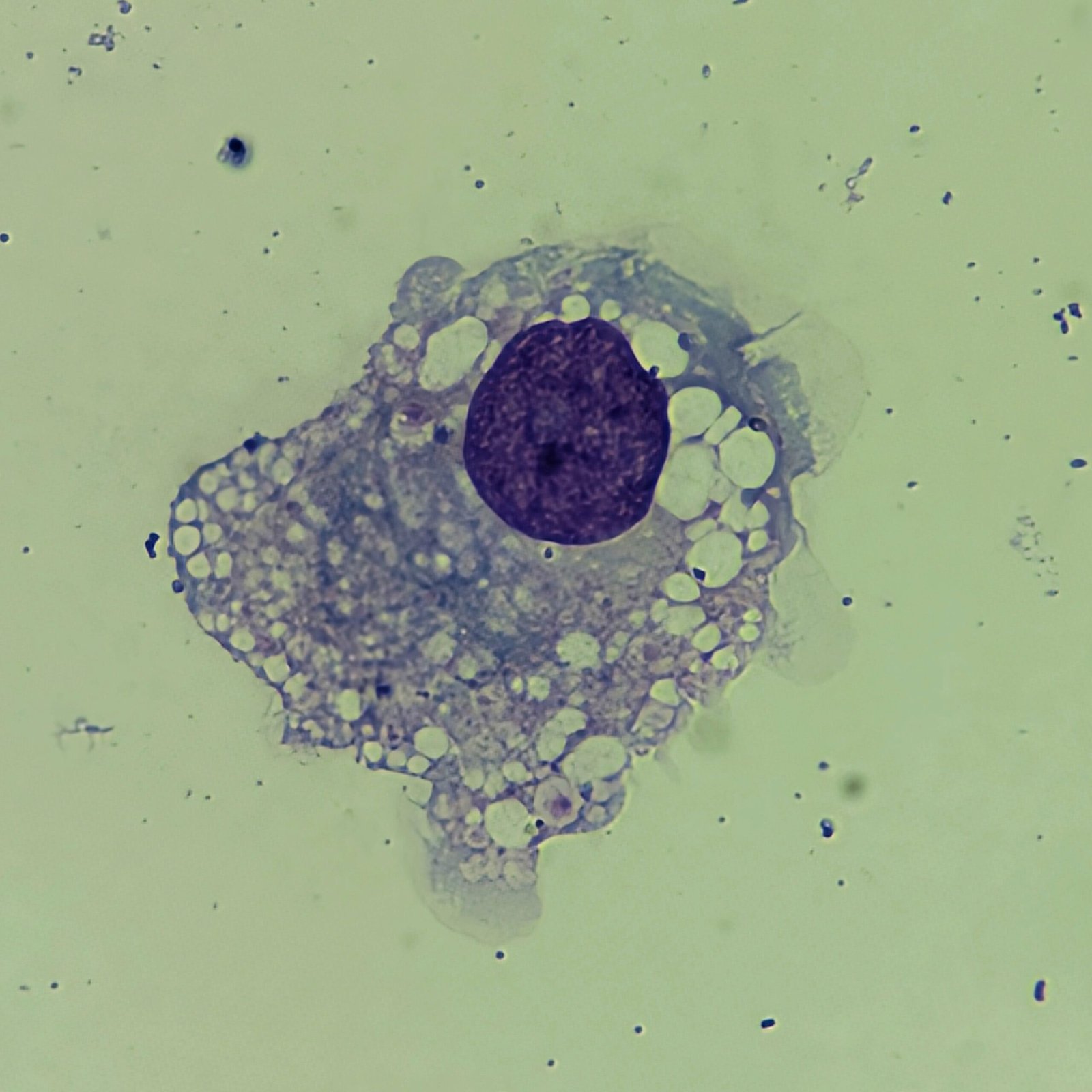 Macrophage in Body Fluid