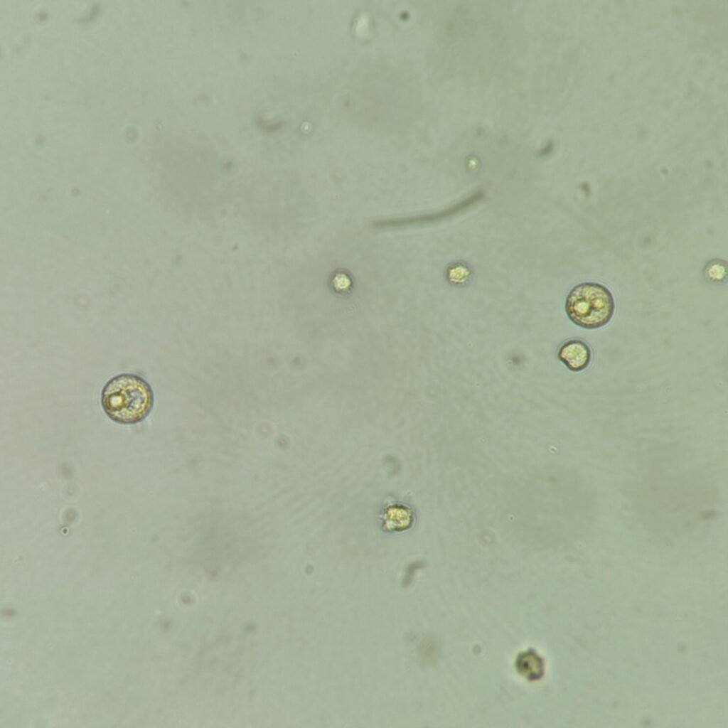 Macrophages in Urine, White Blood Cells