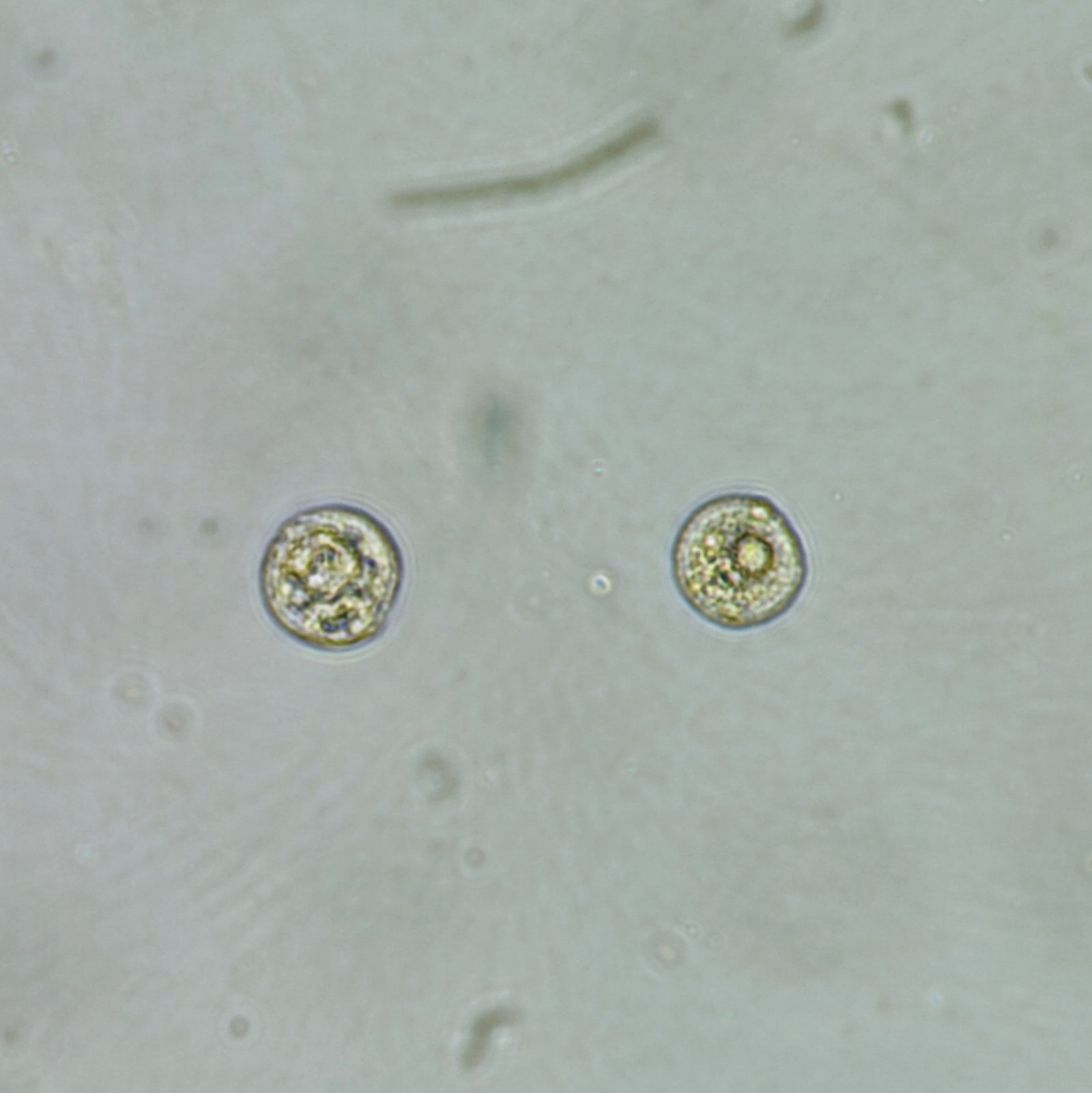 Mysterious Cells in Urine