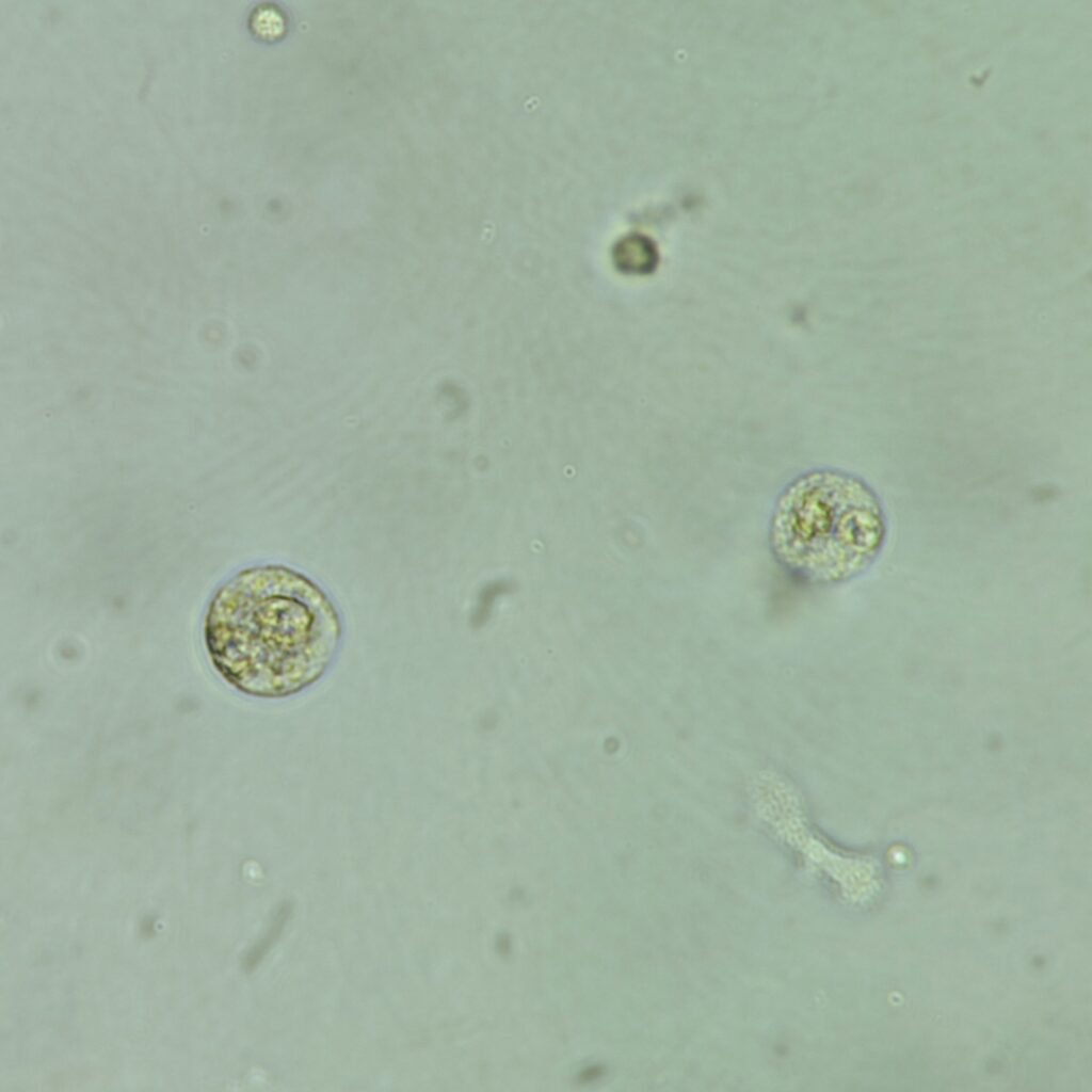 Macrophages in Urine, White Blood Cells