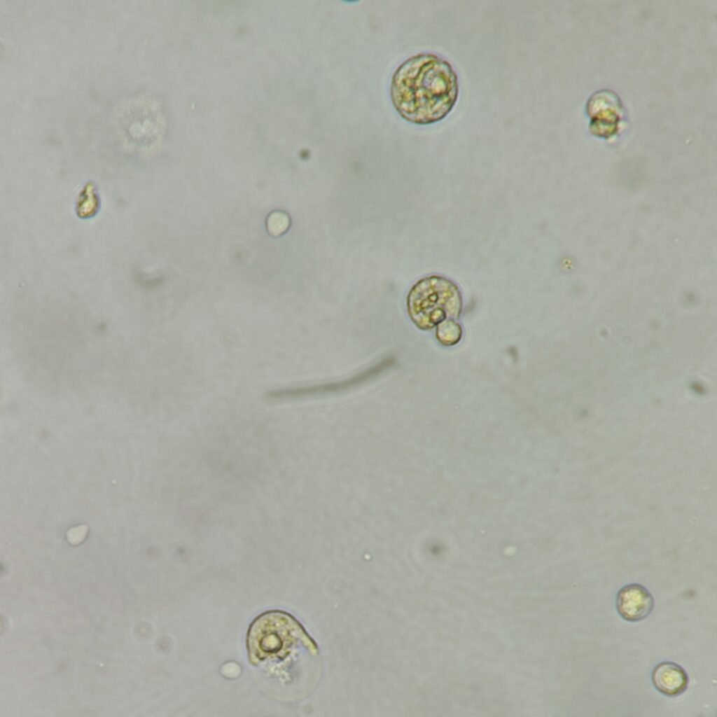 Macrophages in Urine, White Blood Cells