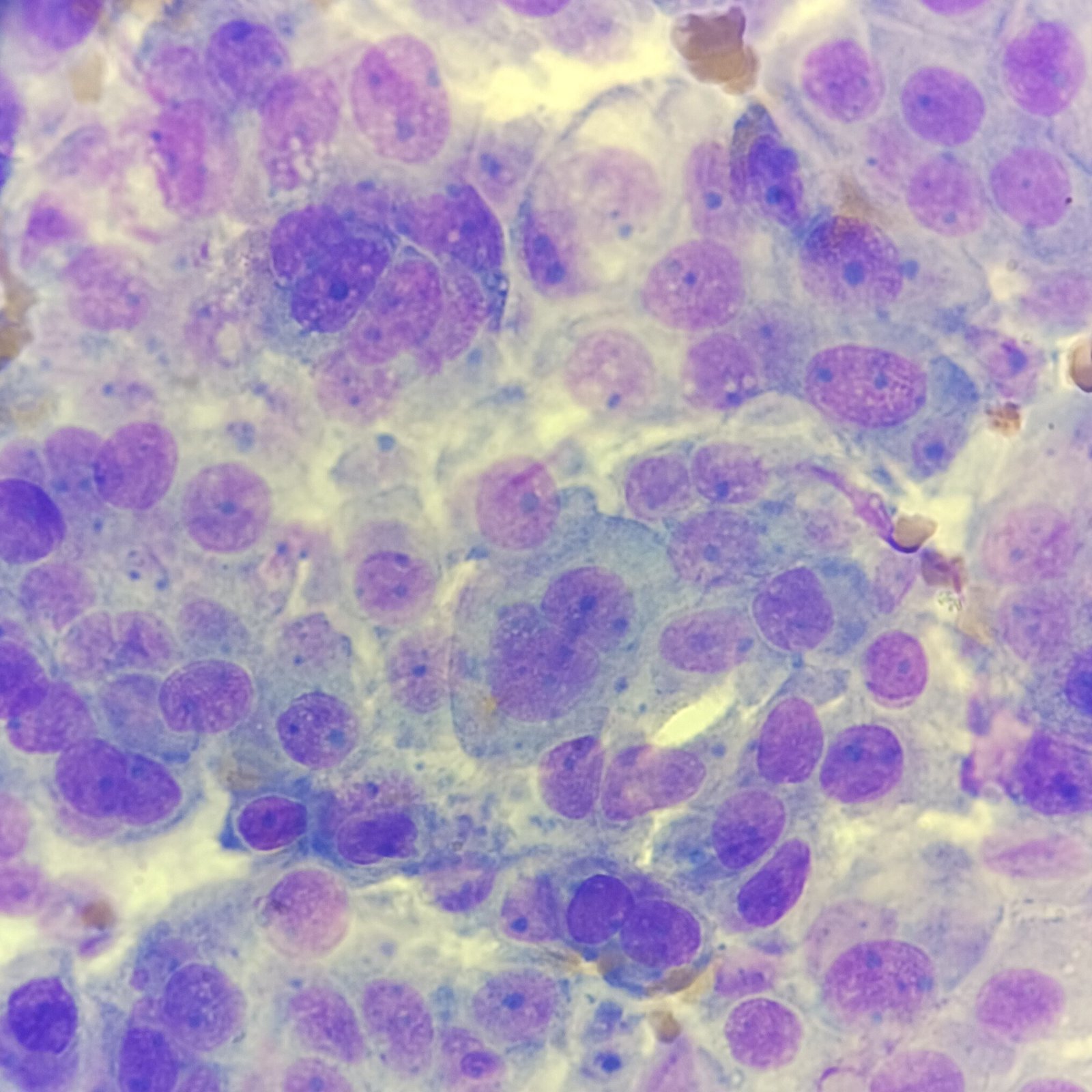 Malignant Cells in Body Fluid