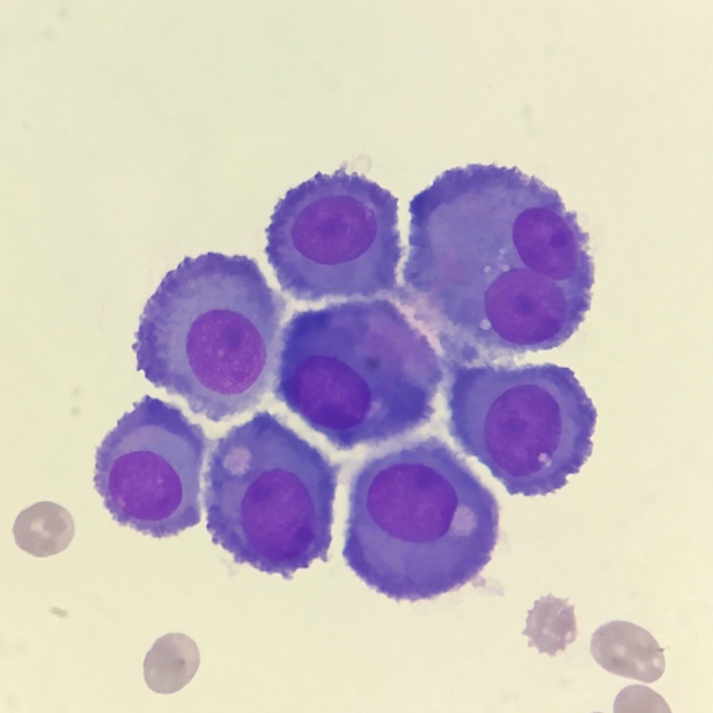 Mesothelial Lining Cell in Body Fluid